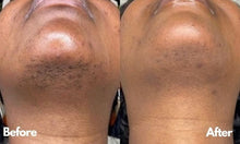 Load image into Gallery viewer, Laser Hair Removal Kit