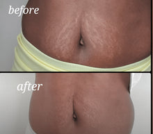 Load image into Gallery viewer, Scar Eraser and Stretch Mark Combo Pack