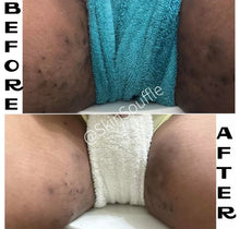 Load image into Gallery viewer, HS Bundle (Hidradenitis suppurativa)- Dark Spot Eraser, Turmeric Lip scrub, Razor Bump Corrector, Turmeric Soap & Tea Tree Facial Cream