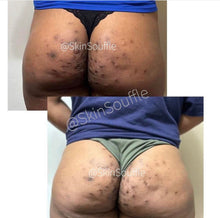 Load image into Gallery viewer, HS Bundle (Hidradenitis suppurativa)- Dark Spot Eraser, Turmeric Lip scrub, Razor Bump Corrector, Turmeric Soap & Tea Tree Facial Cream