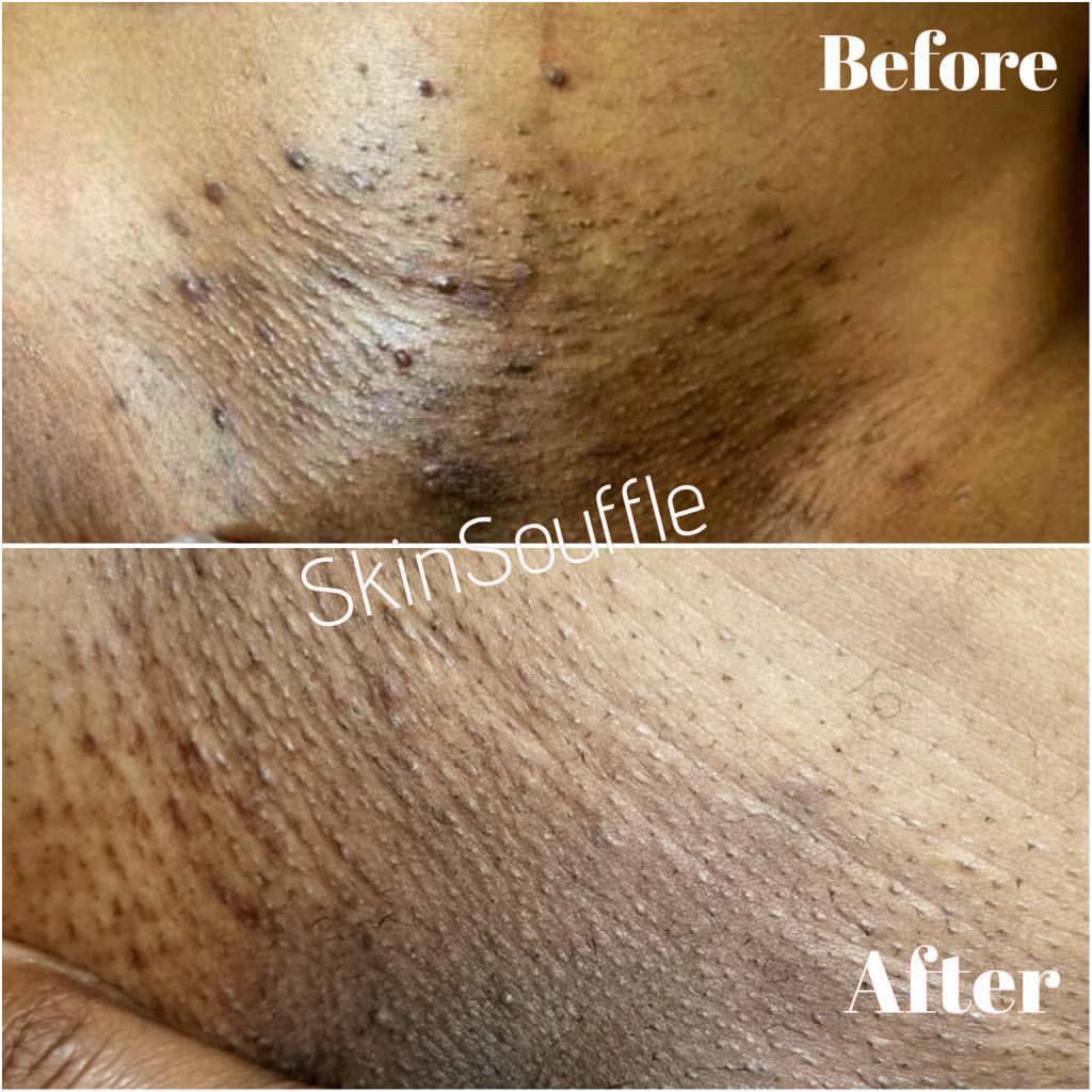 It's SKIN:o'clock with @SkinSouffle 💫 Do you struggle with dark spots,  razor bumps 🪒& hyperpigmentation? exfoliate, moisturize