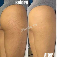 Load image into Gallery viewer, Scar Eraser and Stretch Mark Combo Pack