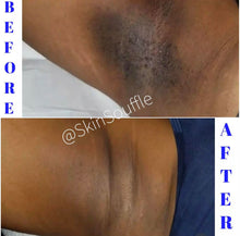 Load image into Gallery viewer, SUPER STRONG Dark Spot Eraser for face & Body