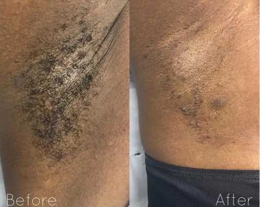 Laser Hair Removal Kit