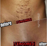 Intimate Razor Bump Corrector