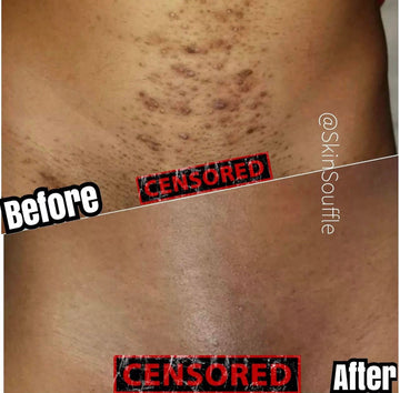 Intimate Razor Bump Corrector