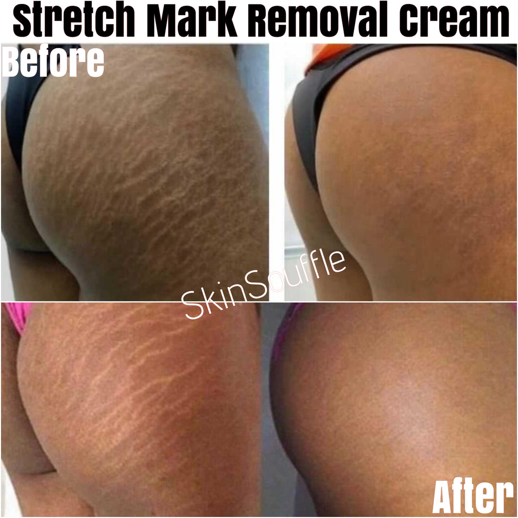 Stretch Mark Removal Cream
