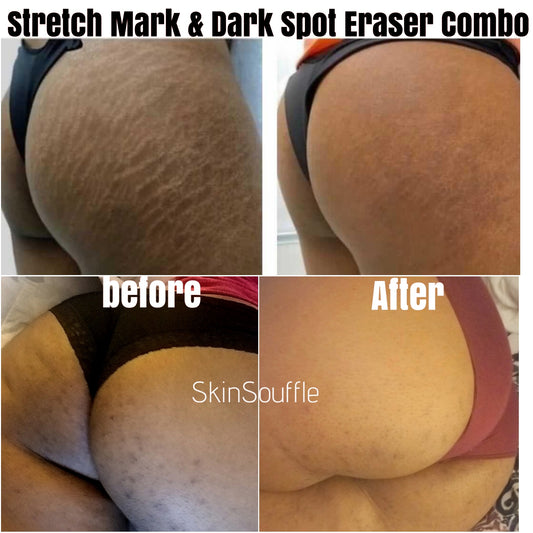 Stretch Mark Removal & Intimate Dark Spot Eraser Combo