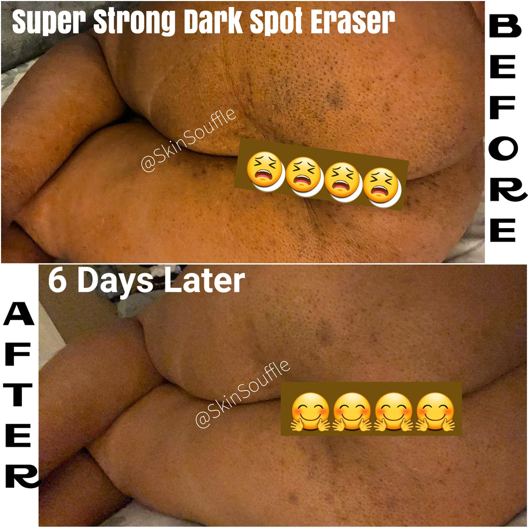 SUPER STRONG Dark Spot Eraser for face & Body