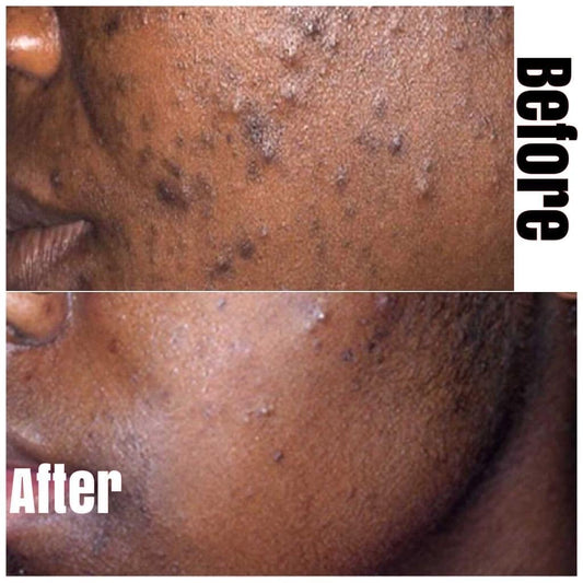 Tea Tree Acne Facial Cream
