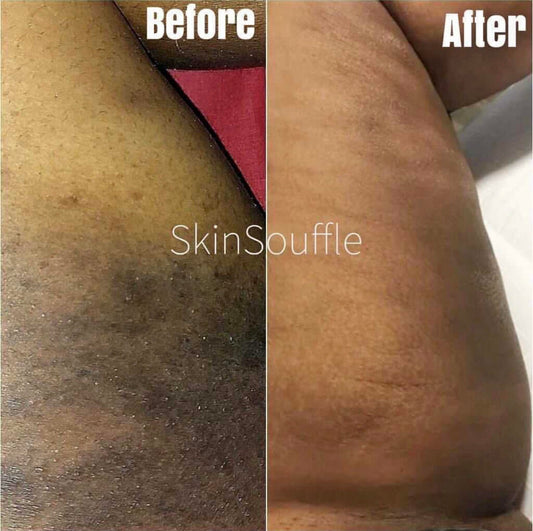 Scar Eraser and Stretch Mark Combo Pack