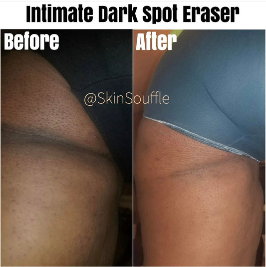 Triple (3) Pack Dark Spot Eraser